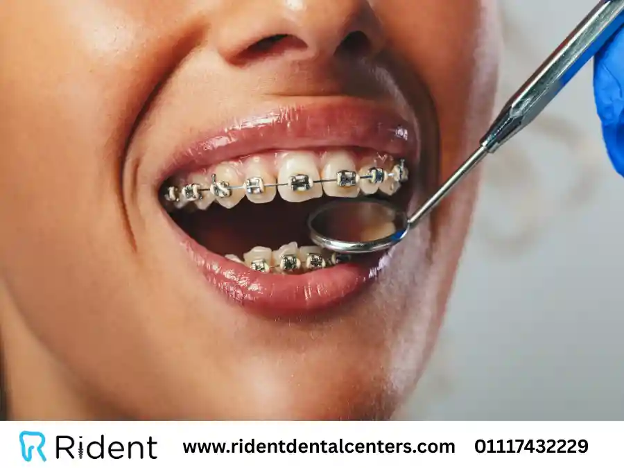 شروط تركيب تقويم الأسنان: هل تقويم الاسنان يؤثر على العلاقة الزوجية؟ 